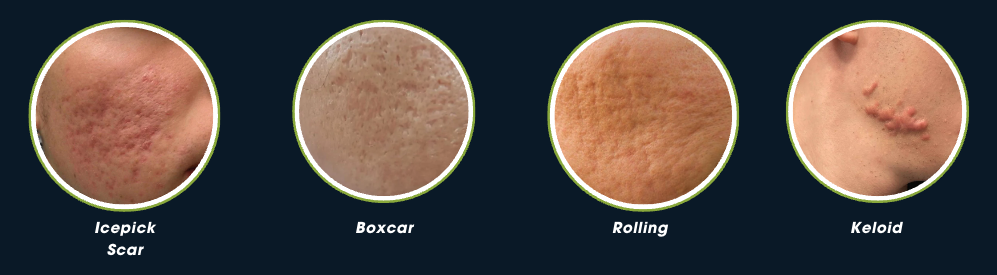 Type of Acne Scars